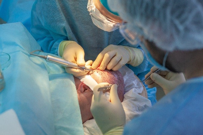 人気歌手 10年ぶり２度目の植毛手術を決心 自分自身に恥を感じない よろず ニュース