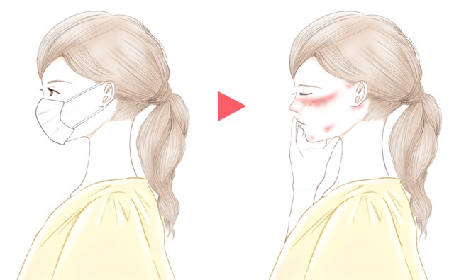 急増の マスク皮膚炎 予防するには こまめに洗顔 すぐに保湿 がとても大切 まいどなニュース