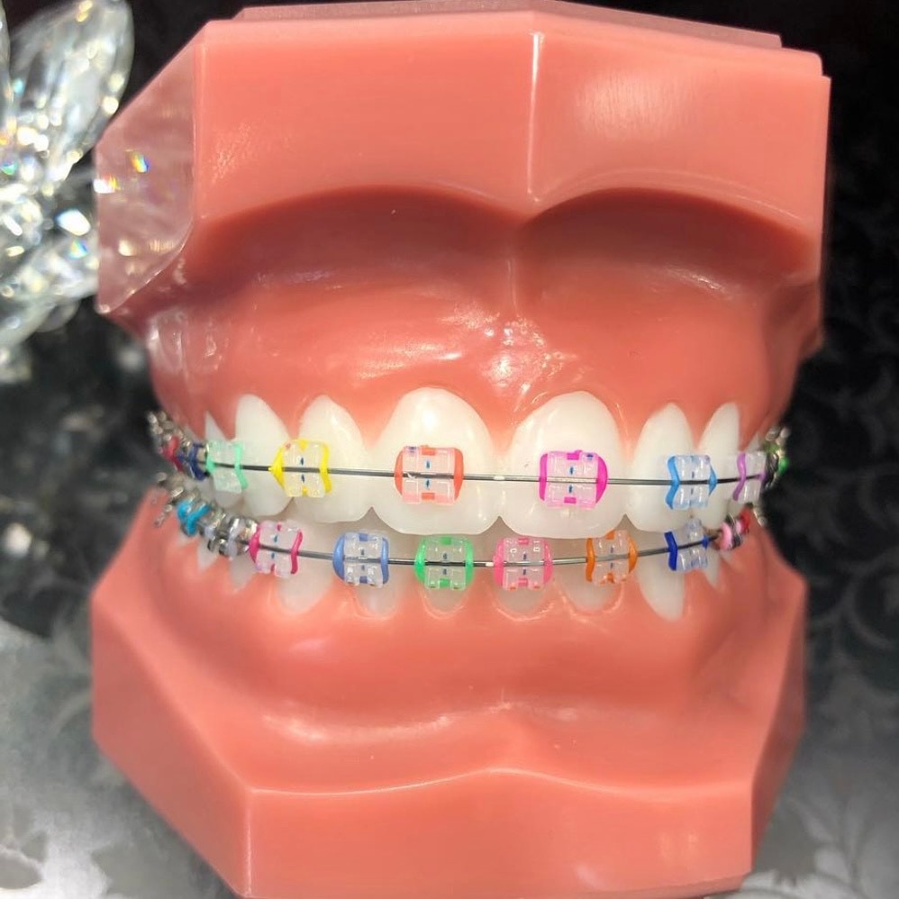 歯列矯正はファッションの一部 嫌だ とならないで かぼちゃ型ハロウィーン仕様も よろず ニュース