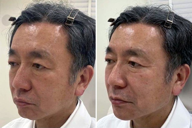 増える男性の美容整形 特に シワ取り に熱視線 オンラインミーティングで気になる男性が急増中 まいどなニュース