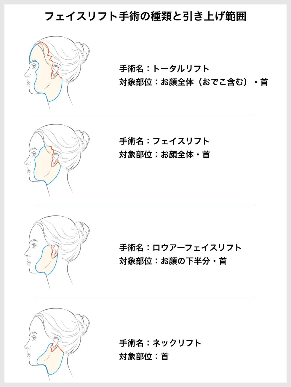 マスクで隠せる今だから マスクで隠せない気になるところを コロナ禍で増える美容整形 人気の施術は まいどなニュース