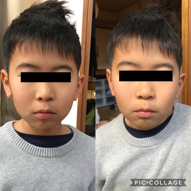 あのイケメン俳優も実践 輪ゴムで小顔に むくみが取れて目もパッチリの裏ワザって まいどなニュース