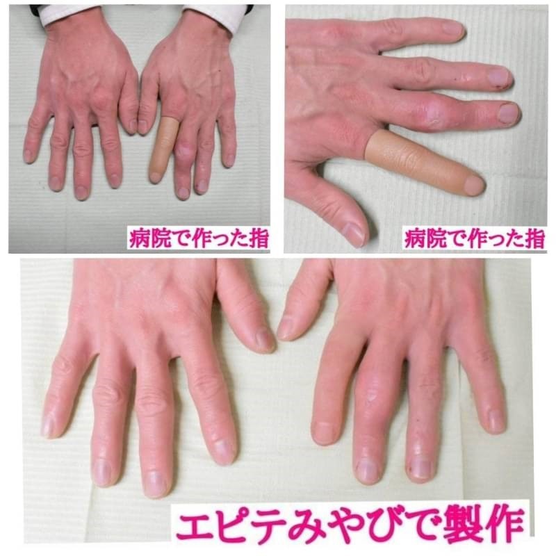 義指、エピテーゼ指 義指、エピテーゼ指、男性用親指