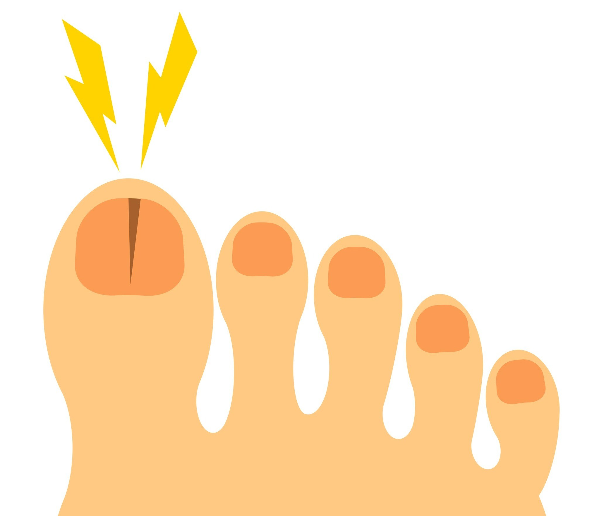 夫の爪がはがれた 妻は病院に行く夫に はがれた爪を持たせた これって正解だった 医師に聞いた